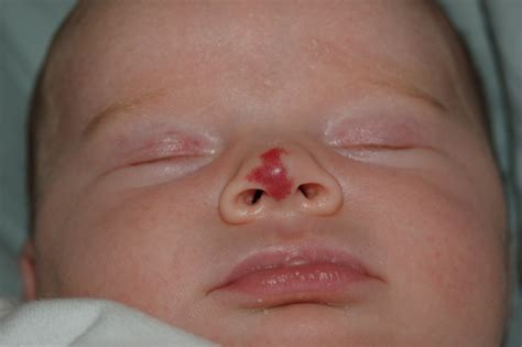 capillary hemangioma - 1 month old | We are documenting the … | Flickr