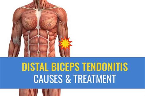 Distal biceps tendonitis – causes and treatment