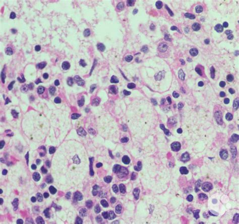 Figure 05: Trephine biopsy showing foamy macrophages with abundant ...