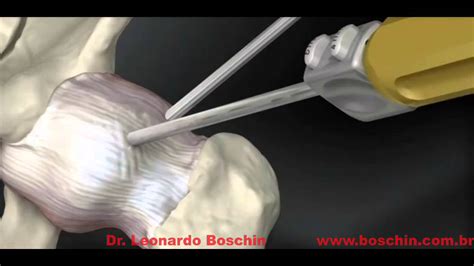 Ankle arthroscopy recovery: Post-Operative Instructions: Ankle Arthroscopy