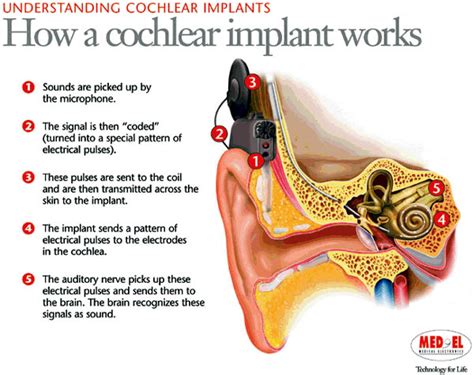 Pin by Margaret Schaut on Speech Therapy in 2021 | Cochlear implant, Cochlear, Deaf education