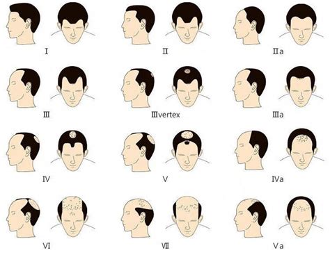 Hairstyles with receding hairline for men - Matching variants for the hairline #hairline # ...