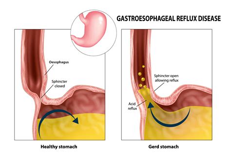 Barrett’s Oesophagus in Singapore - Alpha Digestive & Liver Centre