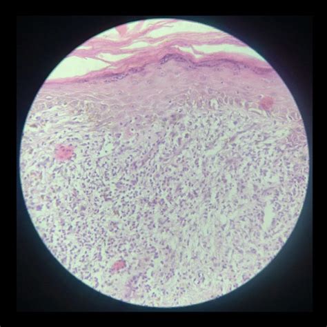 Typical Wickham striae in the posterior part of the buccal mucosa ...