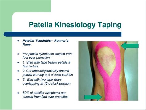 Image result for how to correct patellar maltracking with theraband kinesiology tape ...