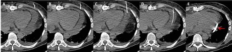 Real-Time Image-Guided Pericardial Drain Placement - American College of Cardiology