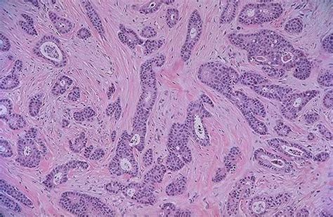 Invasive Ductal Carcinoma - Oncology - Medbullets Step 2/3