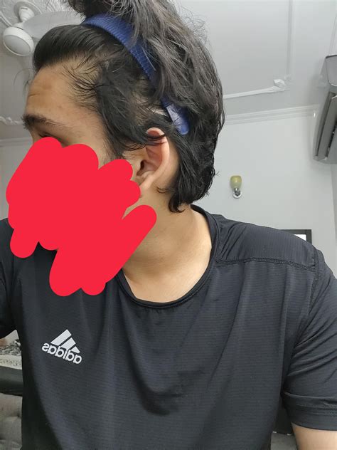 WHAT'S MY NORWOOD SCALE?Up on finasteride for 5 and half months tho : r/Hairloss