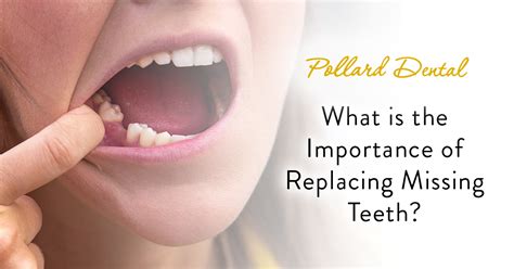 What Is The Importance Of Replacing Missing Teeth? - Pollard Dental