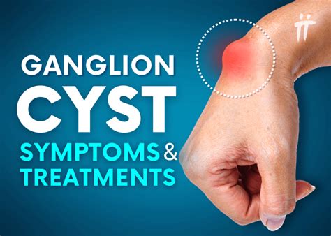 Ganglion Cyst: Symptoms and Treatment Methods - Turan&Turan