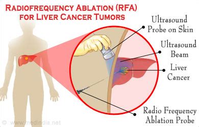 Radiofrequency Ablation (RFA) of various Tumours - Dr. Yadav Munde