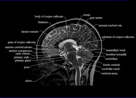 Cross Sectional Anatomy | MRI Brain Sagittal Anatomy | Free MRI brain ...