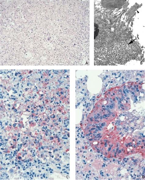 Lung of prairie dog infected with monkeypox virus, showing abundant... | Download Scientific Diagram