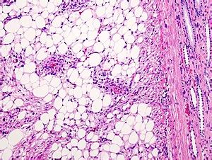 Tuberous sclerosis - Libre Pathology