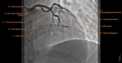 Anatomy of the coronary arteries: normal anatomy | e-Anatomy