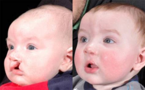 Unilateral Cleft Lip Palate Before & After Pictures in Dallas, TX