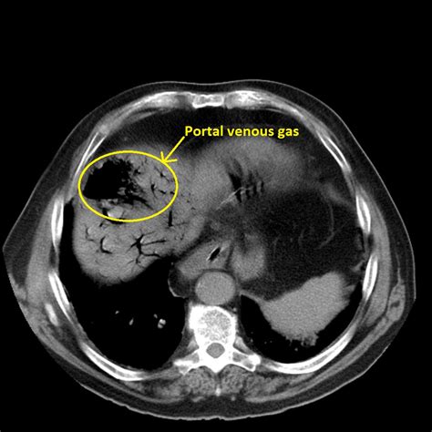 Mesenteric ischemia CT - wikidoc