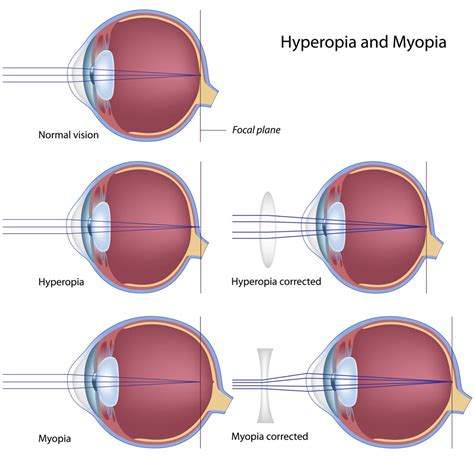 hyperopia-and-myopia - Fort Worth Eye Associates