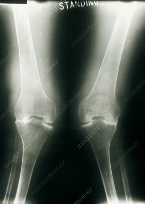 X-ray of knee joints with rheumatoid arthritis - Stock Image - M110/0438 - Science Photo Library