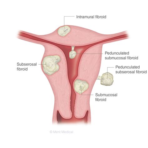 Symptoms of Uterine Fibroids