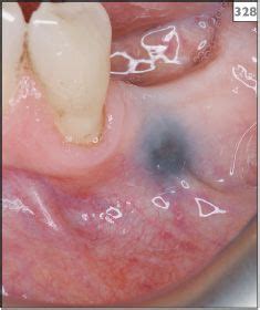 7 Pigmentation (including bleeding) | Pocket Dentistry