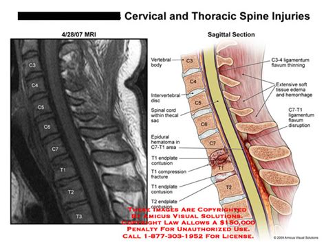 AMICUS Illustration of amicus,injury,spine,cervical,thoracic,C3,C4,C5,C6,C7,T1,T2,T3,vertebrae ...