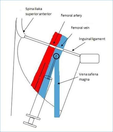 9: Femoral venous catheterization. | Download Scientific Diagram