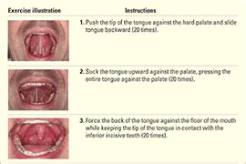 Oropharyngeal Exercises to Treat Snoring