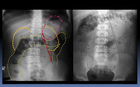 Anatomía Radiológica de Pelvis y Abdomen