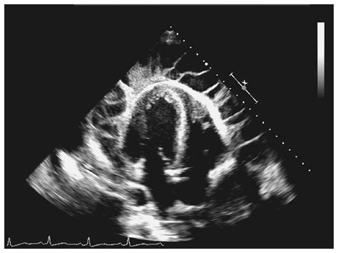 Uremic Pericarditis | NEJM