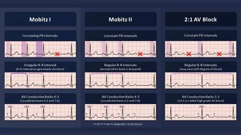 measuring qrs complex Archives - Student Nurse Life