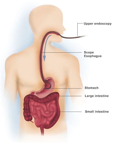 Upper and Lower Endoscopy - Dr. Ahmed Farah Abdulrahman