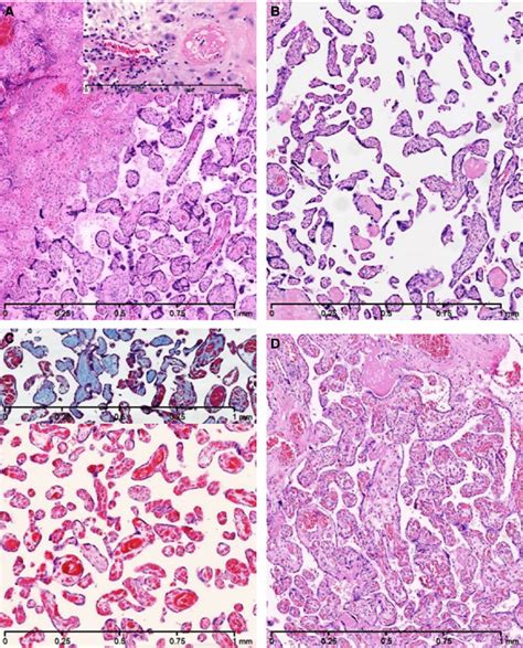 Placental histology (original magnification 50X). Haematoxylin-eosin... | Download Scientific ...