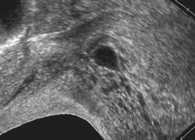 Hydatidiform Mole Imaging: Practice Essentials, Computed Tomography, Magnetic Resonance Imaging