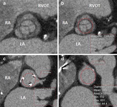 a An 84-year-old male with failed bioprosthetic aortic valve for ...