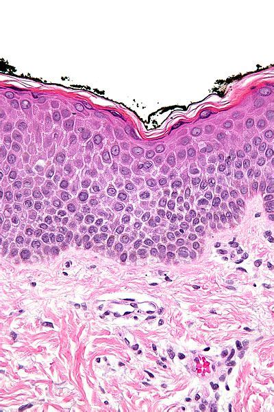 Spongiosis (dermatopathology) - WikiLectures