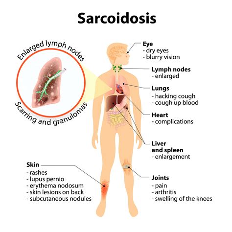 Sarcoidosis of the Skin (Cutaneous Sarcoidosis) — Foundation for Sarcoidosis Research