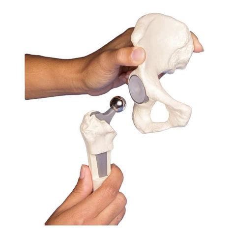 Erler-Zimmer Hip implant model | DocCheck Shop