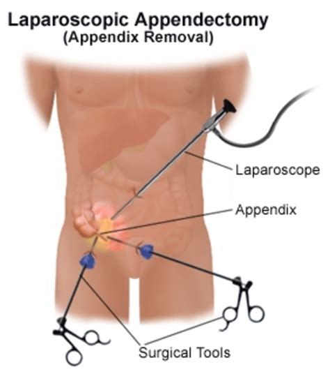 Symptoms of Appendicitis, and Ruptured Appendix....know what to look ...