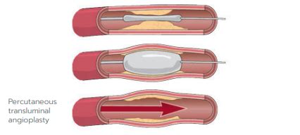 Intra > Procedures and treatments > Interventional radiology > Vascular > Leg Arteriogram