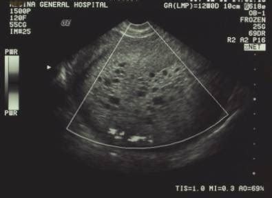 Partial Molar Pregnancy