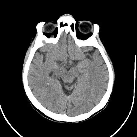 Choroidal Fissure Cyst Radiology