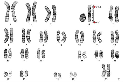 (PDF) Ring Chromosome 4 in a Child with Multiple Congenital Abnormalities: A Case Report and ...