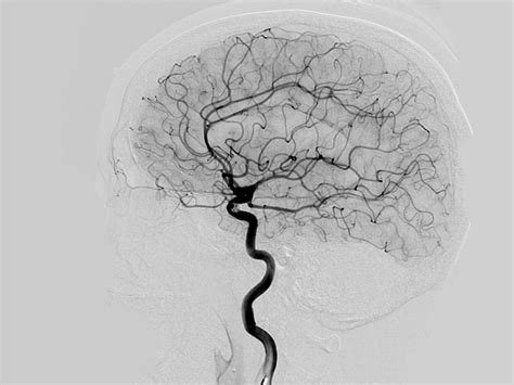 Cerebral Angiogram/DSA