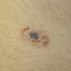 Blue areas on dermoscopy of a congenital nevus with Meyerson phenomenon - Journal of the ...