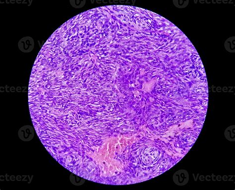 Photomicrograph of a schwannoma, a benign soft tissue tumor of peripheral nerve sheath. 8930990 ...