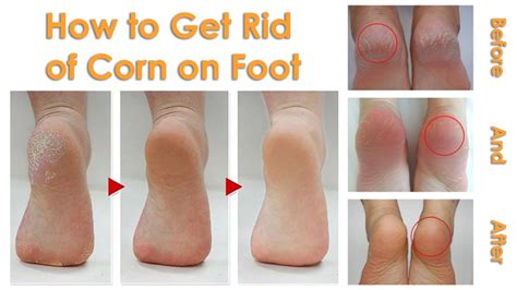 Foot Corn Removal Remedies – Foot Care Tips