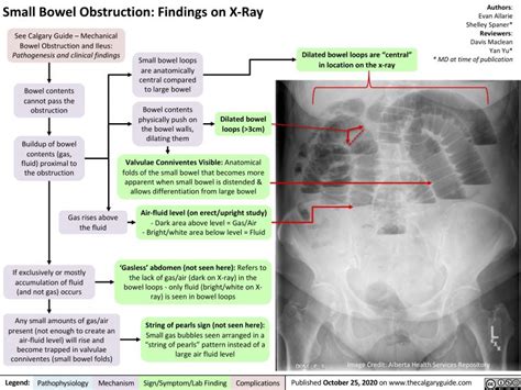 Small Bowel Obstruction: Findings on X-Ray | Calgary Guide