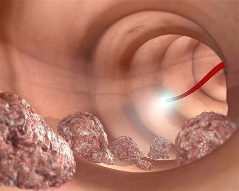 Genetic Mutations Associated With Liver Metastasis From Primary ...