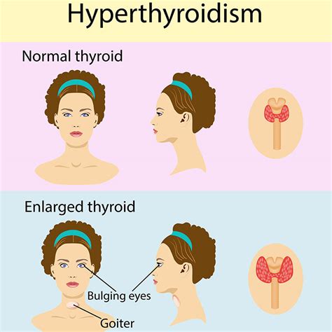 Enlarged Thyroid Women